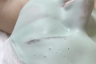 Що таке карбокситерапія?